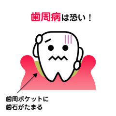 【歯周病の原因】歯周ポケットとは？