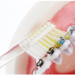 矯正中の方におすすめの歯ブラシ
