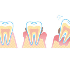 【歯周病】オススメの歯ブラシは「やわらかめ」
